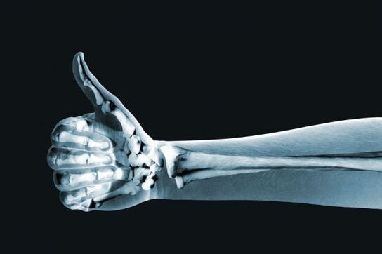 A radiografía utilízase para diagnosticar a dor nas articulacións dos dedos