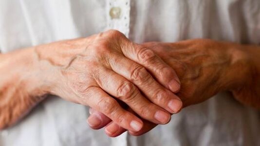 artrite reumatoide como causa de dor nas articulacións dos dedos