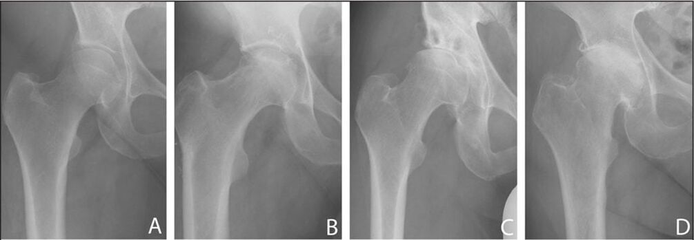 Fases de desenvolvemento da artrose da articulación da cadeira en raios X