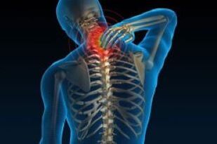 A osteocondrose cervical leva á dor no pescozo