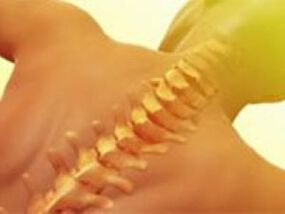 Osteocondrose - enfermidade da columna vertebral