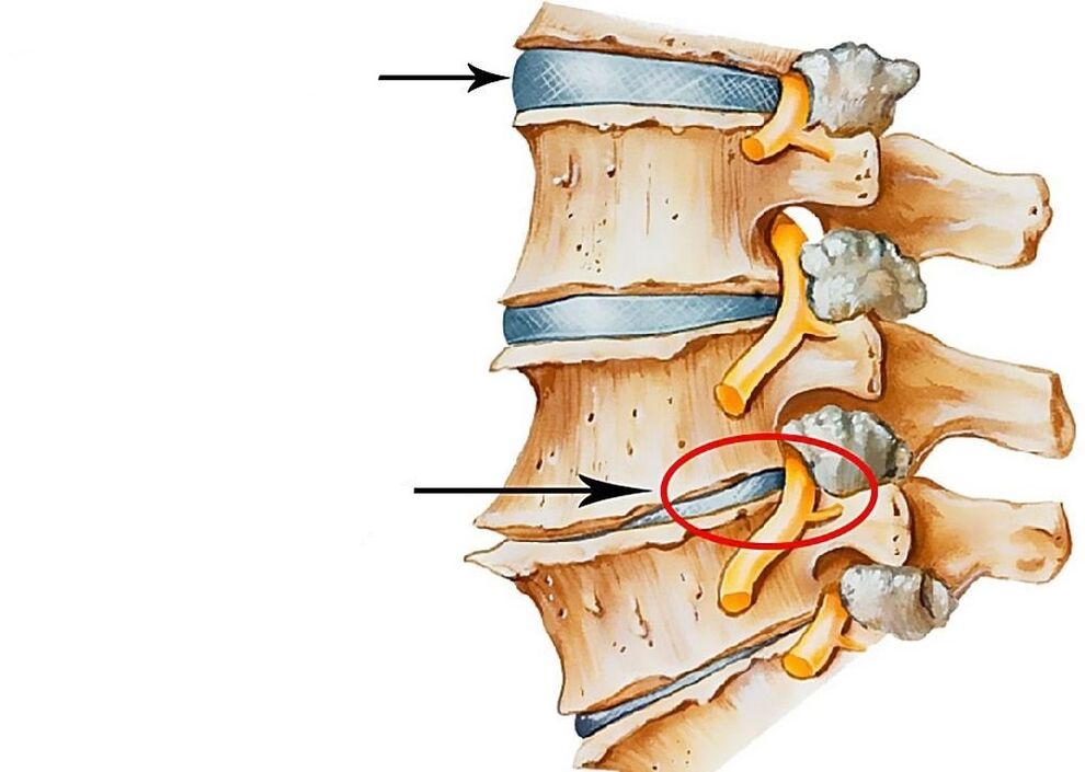 Representación de discos intervertebrais sans e deformados
