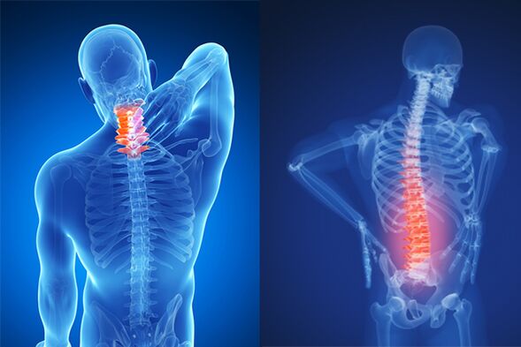 Osteocondrose da columna cervical e lumbar