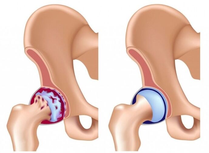 Danos na articulación da cadeira debido á artrose