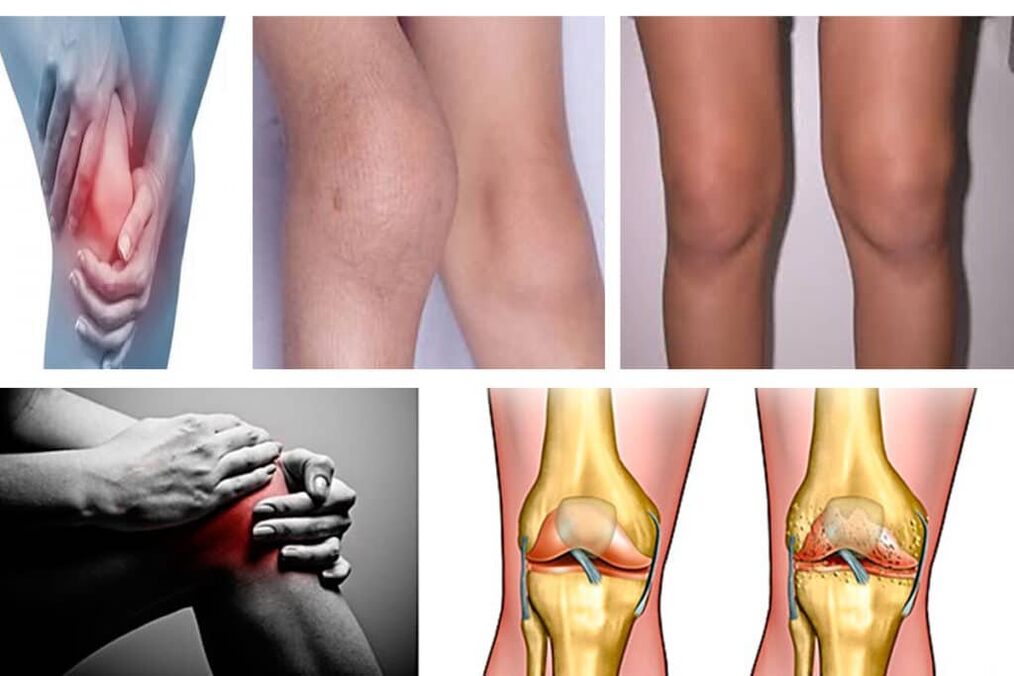 Osteoartrite, que é