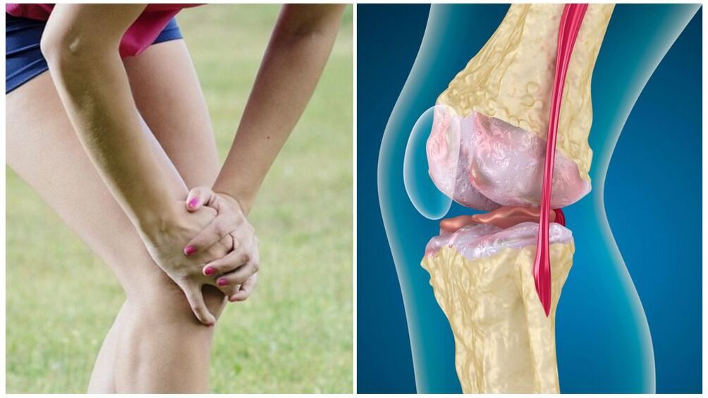 Síntomas da osteoartrite
