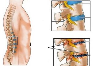 As causas da osteocondrose da columna lumbar
