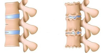 Como recoñecer a presenza de osteocondrose da columna lumbar